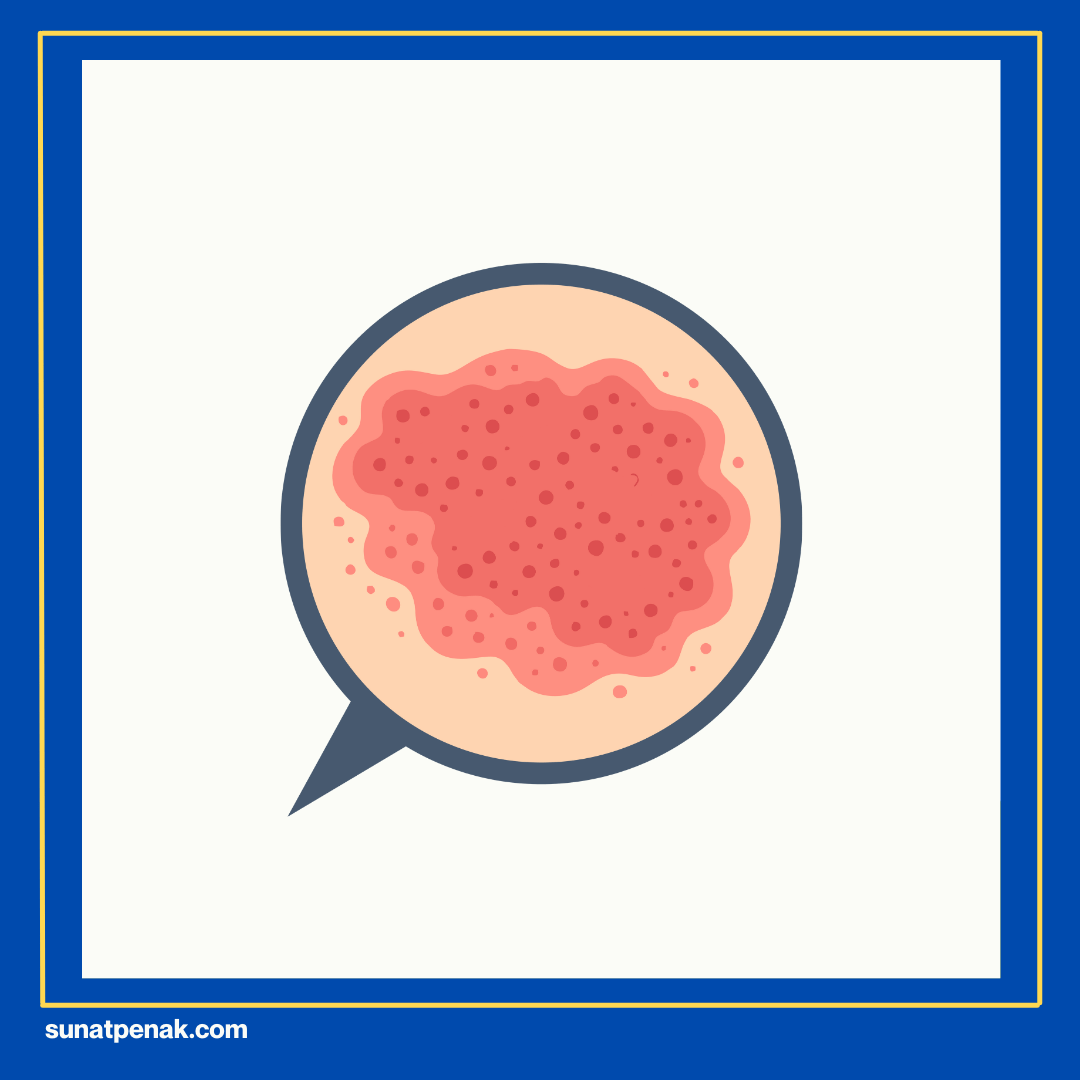 Adanya Jaringan Menempel (Skin Bridge)